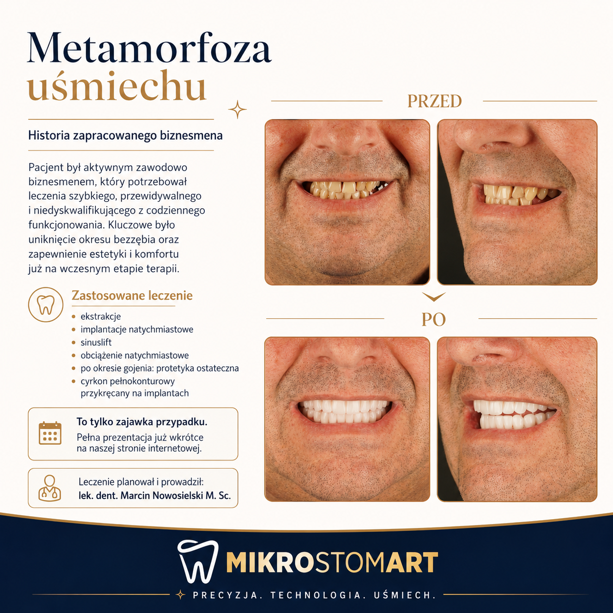 Metamorfoza uśmiechu — przed i po pełnej rekonstrukcji na implantach, klinika Mikrostomart Opole